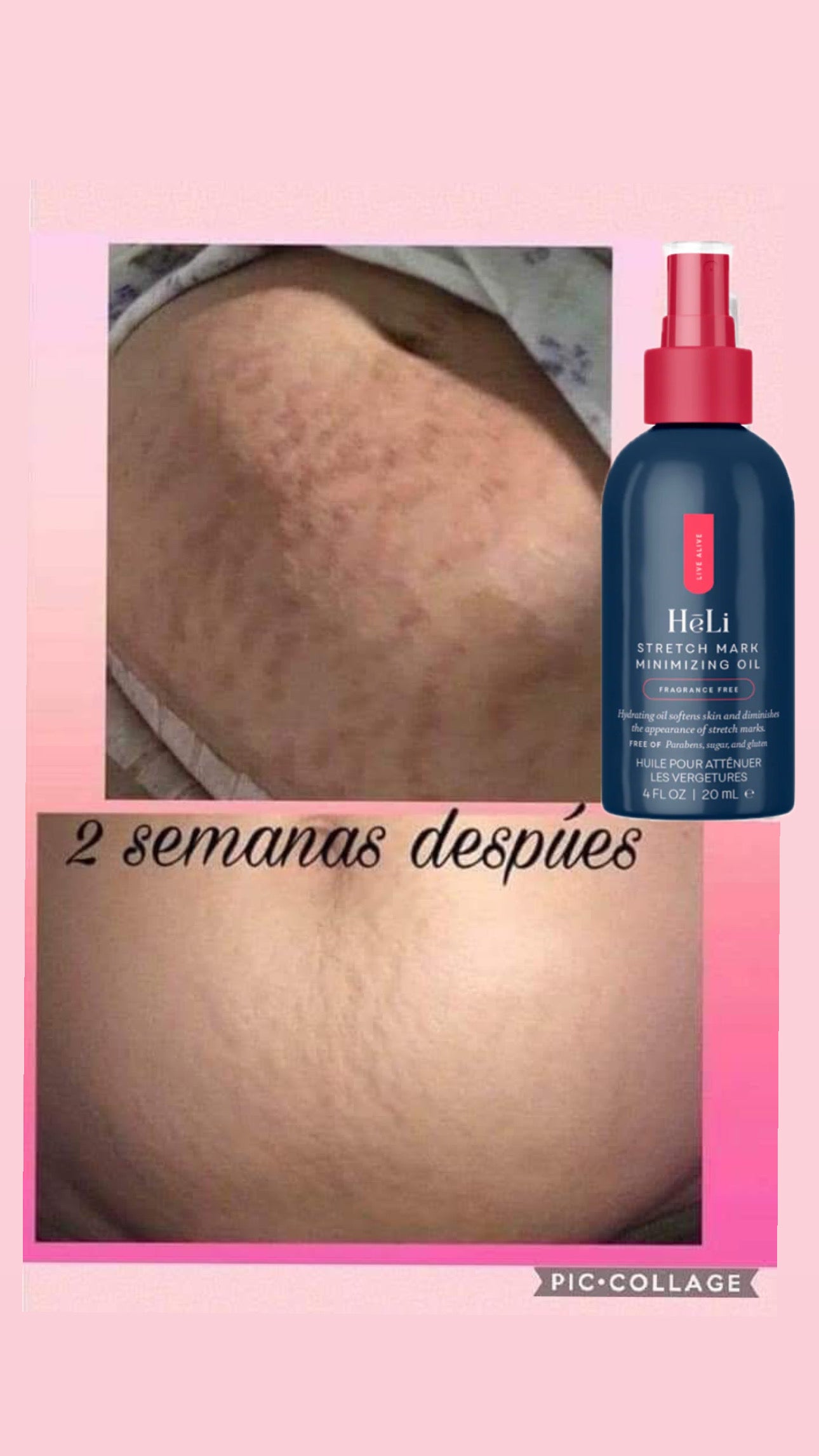 Strech Mark Oil